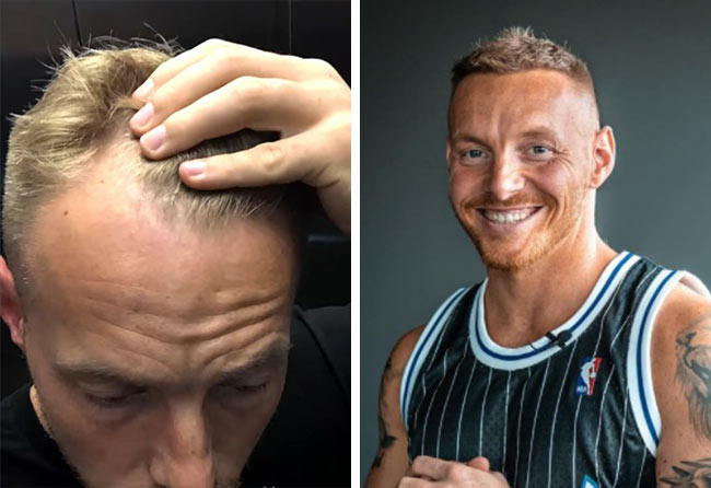 foto del Prima e dopo il trapianto di capelli zaffiro da 3100 innesti fatto da coach stef