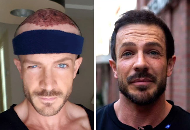foto del prima e dopo il trapianto di capelli zaffiro da 3500 innesti fatto da simon teichmann