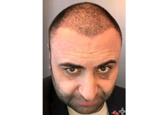 foto del Prima e dopo il trapianto di capelli zaffiro da 4200 innesti fatto da Murat Kizilkaya quando sono passati 3 mesi