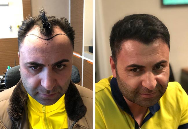 Foto di Prima e dopo il trapianto di capelli zaffiro con 4200 innesti fatto da Murat Kizilkaya
