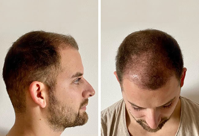 foto del Prima e dopo il trapianto di capelli zaffiro da 4200 innesti fatto da Marcel Oliva quando sono passati 3 mesi