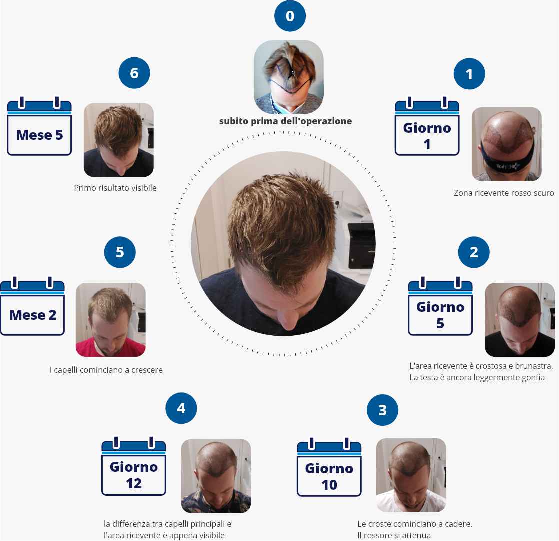 infografica che spiega in dettaglio il processo di guarigione dopo il trapianto di capelli