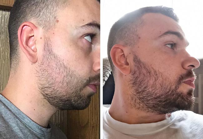 foto del prima e dopo il trapianto di barba zaffiro da 2700 innesti fatto da nico mueller quando sono passati 3 mesi
