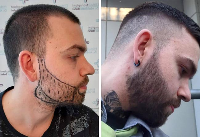 foto del prima e dopo il trapianto di barba zaffiro da 2700 innesti fatto da nico mueller