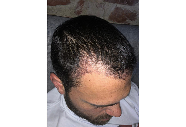 foto del Prima e dopo il trapianto di capelli zaffiro da 3150 innesti fatto da stefan dunkel quando è passato 1 mese