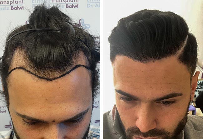 Foto di Prima e dopo il trapianto di capelli zaffiro con 3150 innesti fatto da stefan dunkel