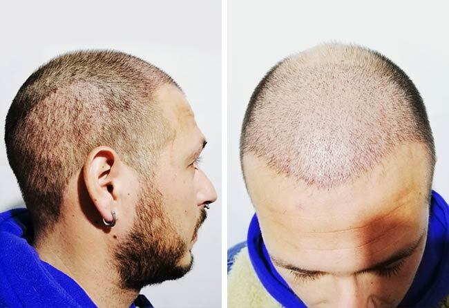1 mese dopo il trapianto di capelli zaffiro da 4200 innesti di Jorge Díaz