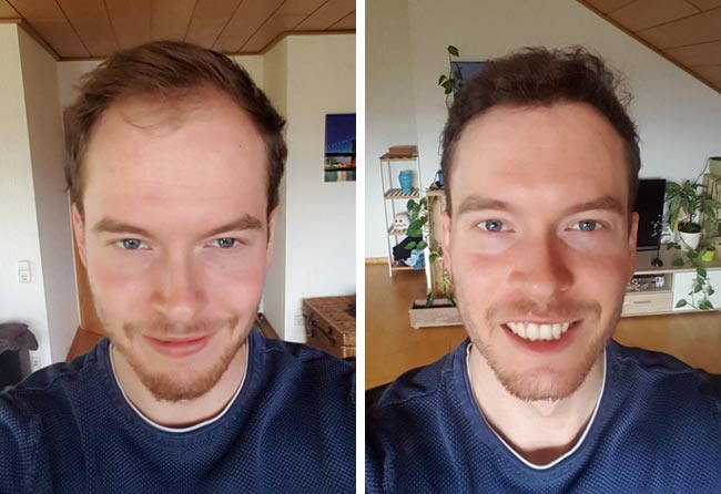 foto di prima e dopo il trapianto di capelli DHI da 3500 innesti di Lukas Jaeger