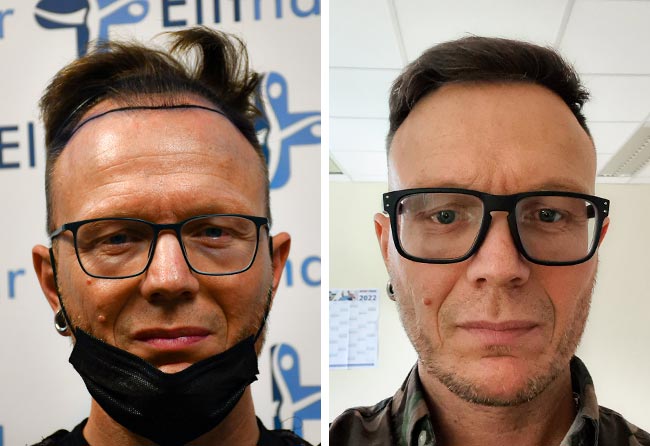 prima e dopo il trapianto di capelli DHI da 4500 innesti di Stefan Kräuter