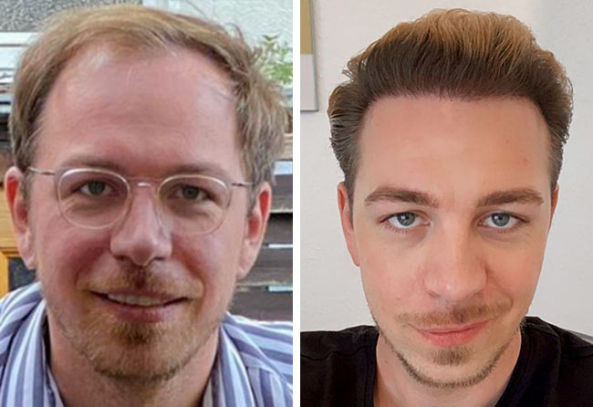 Prima e dopo il trapianto di capelli DHI da 4500 innesti di Tobias Plümacher