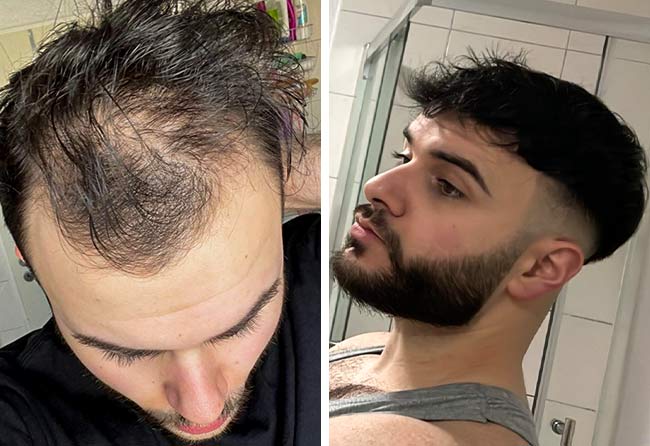 Prima e dopo il trapianto di capelli dhi da 4700 innesti di Okan Yueksel