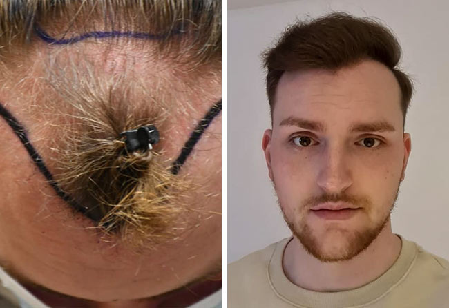 Prima e dopo il trapianto di capelli zaffiro da 4200 innesti di Marc Stehr