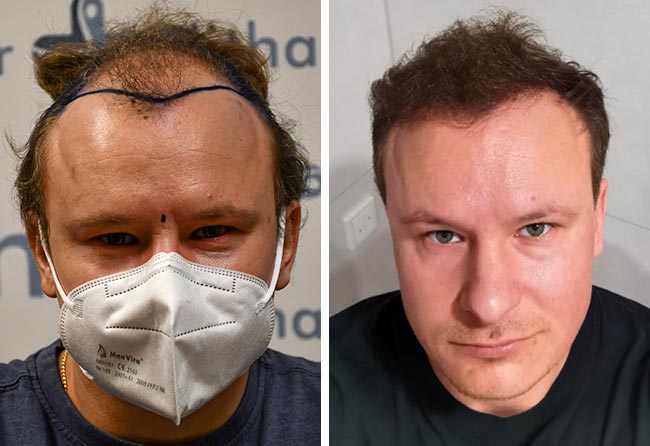 Prima e dopo il trapianto di capelli zaffiro da 4200 innesti di Sergej Weresomski