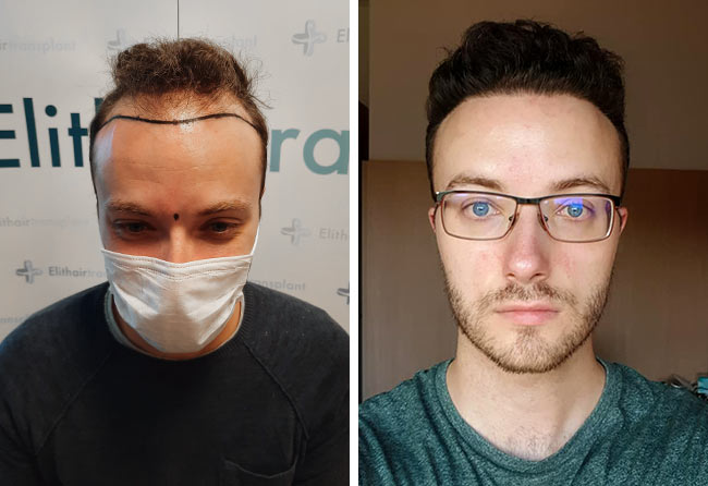 foto prima e dopo il trapianto di capelli zaffiro da 4500 innesti di Didac Scheffler
