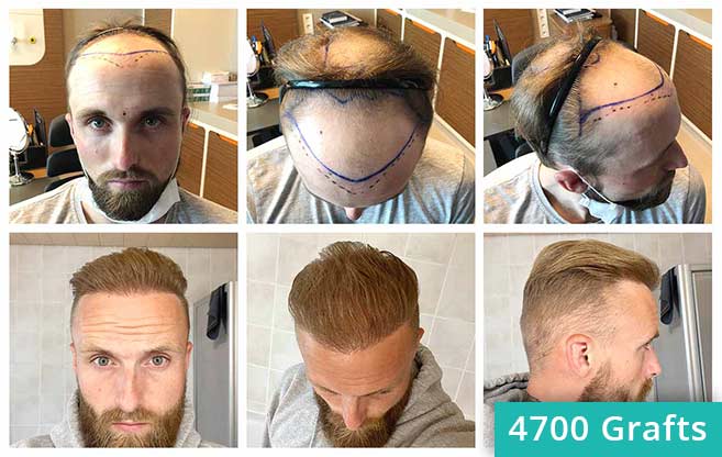 foto di prima e dopo il trapianto di capelli di Frederik Giger