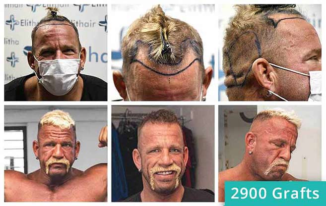 Prima e Dopo il trapianto di capelli di Hollywood Matze 2900 innesti