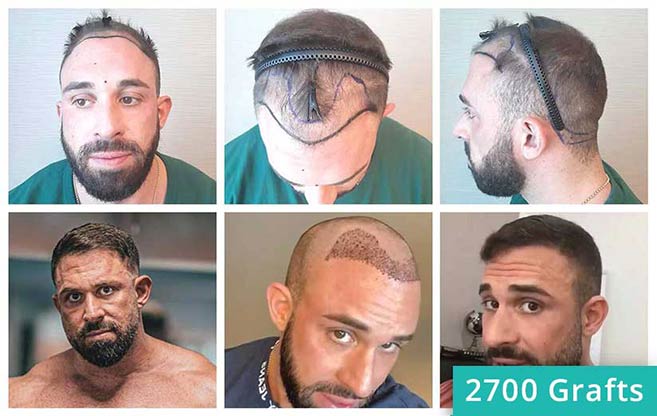 Prima e Dopo il trapianto di capelli di Kevin Wolter