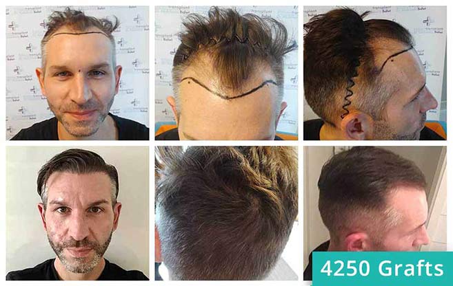 Prima e Dopo il trapianto di capelli di Thomas Schreier