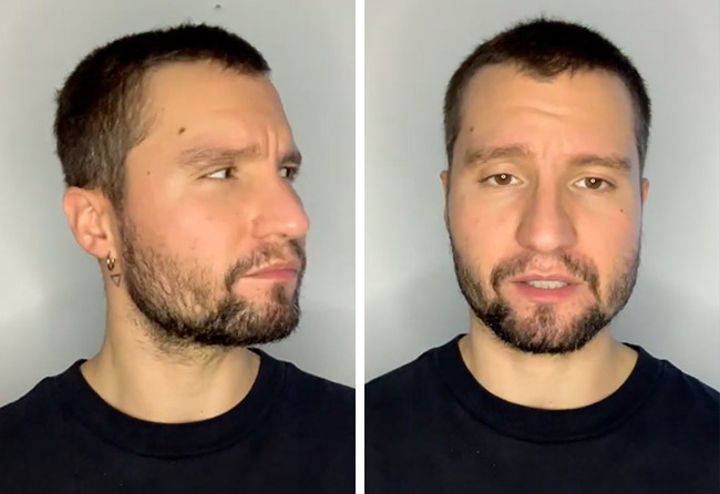 Risultato dopo 2 mesi dal trapianto di barba zaffiro da 3500 di Dominik Schmitz