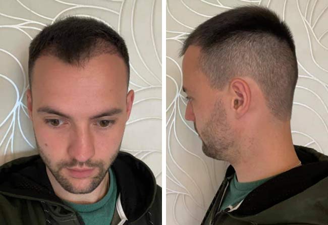 Risultato dopo 2 mesi dal trapianto di capelli zaffiro da 2700 innesti di Alexander Volwerk