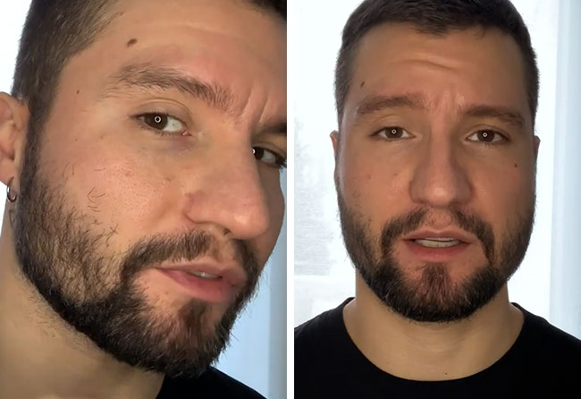 Risultato dopo 3 mesi dal trapianto di barba zaffiro da 3500 di Dominik Schmitz