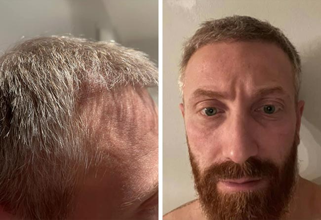 Risultato dopo 3 mesi dal trapianto di capelli DHI da 4750 innesti di Raffaele Leucci