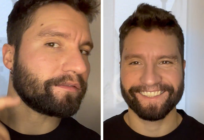 Risultato del trapianto di barba zaffiro da 3500 di Dominik Schmitz