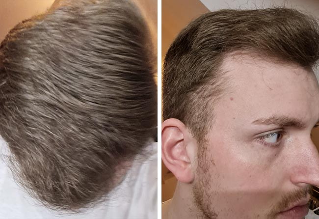risultato del trapianto di capelli zaffiro da 4200 innesti di Marc Stehr