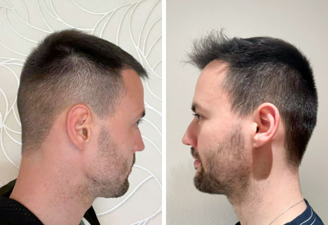 Foto prima e dopo trapianto di capelli di Alexander zona donatrice a 6 mesi