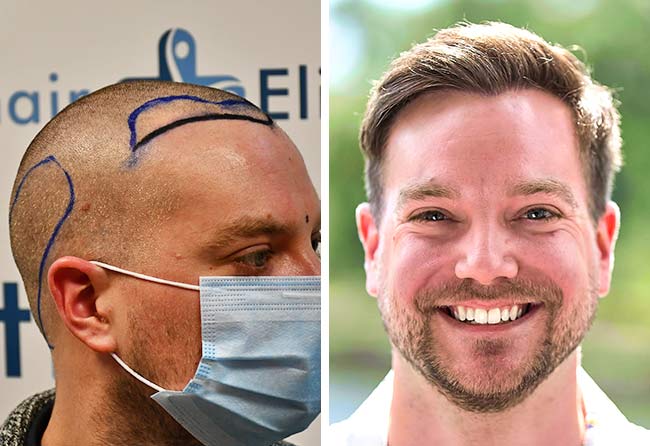 foto prima e dopo il trapianto di capelli DHI da 2000 innesti di Achim Klein