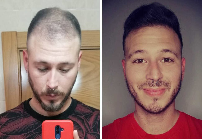 Prima e dopo il trapianto di capelli zaffiro da 4200 innesti di Jorge Díaz