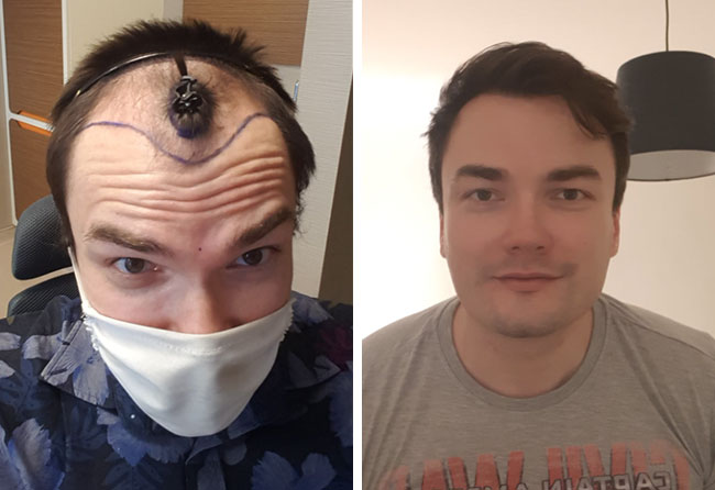 foto di prima e dopo un trapianto di capelli dhi da 3500 innesti di Chris Scholz