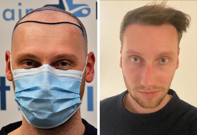 prima e dopo il trapianto di capelli DHI da 3950 innesti di Oliver Dietrich