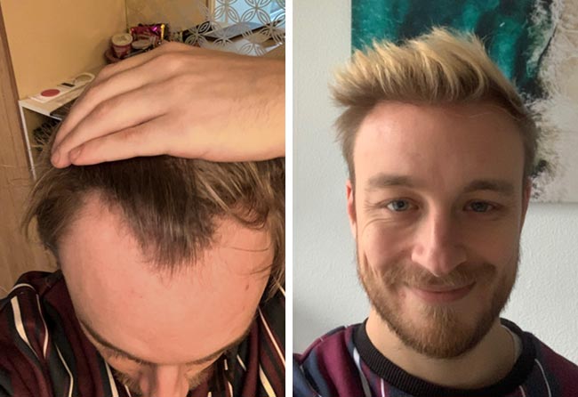prima e dopo il trapianto di capelli DHI da 4200 innesti di Marius Schmiddi