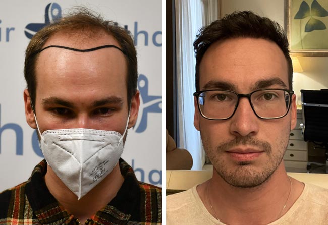 prima e dopo il trapianto di capelli dhi da 4700 innesti di Marc Ploch