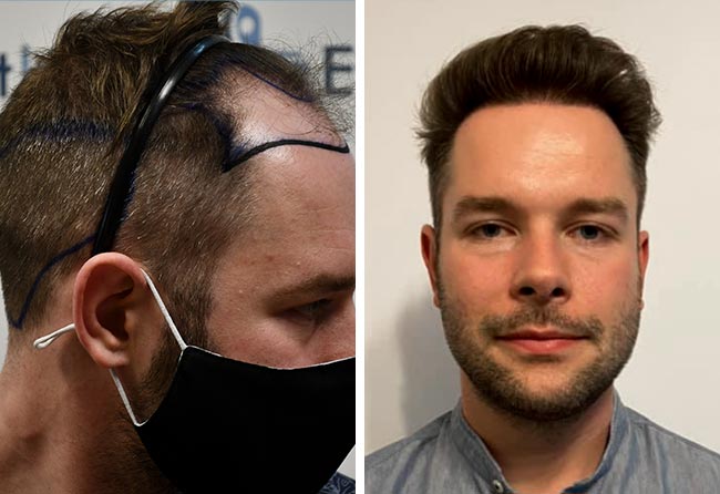 prima e dopo il trapianto di capelli DHI da 4700 innesti di Michael Simma