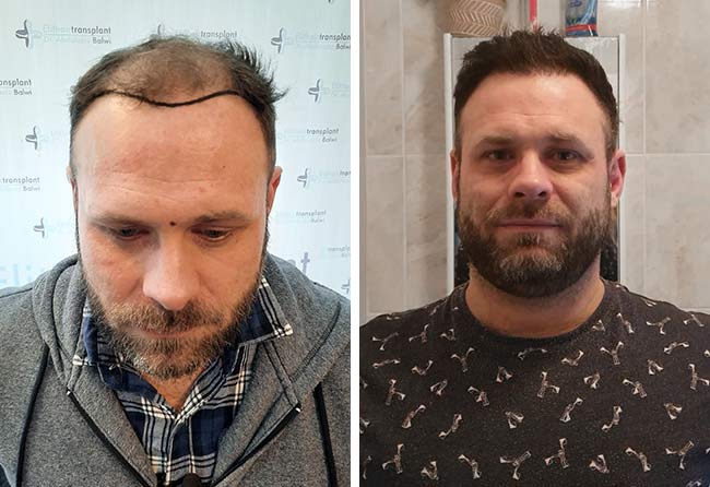 Prima e dopo il trapianto di capelli percutaneo da 3700 innesti di Michael Woulfe