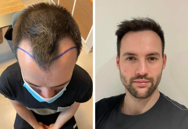 foto prima e dopo il trapianto di capelli zaffiro da 2700 innesti di Alexander Volwerk