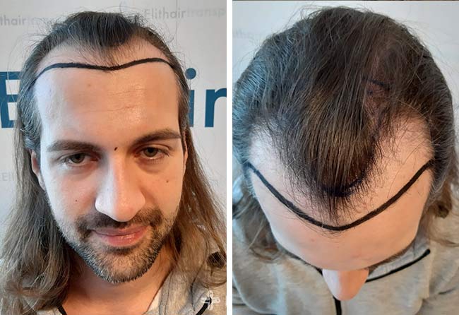foto di prima il trapianto di capelli Zaffiro da 4000 innesti di Cagatay Tuerkseven