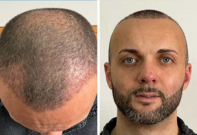 risultato dopo 2 mesi dal trapianto di capelli DHI da 4000 innesti di Salvatore Buoncore