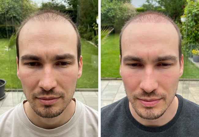 risultato dopo 2 mesi dal trapianto di capelli dhi da 4700 innesti di Marc Ploch