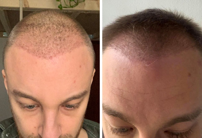 risultato dopo 4 mesi dal trapianto di capelli DHI da 4200 innesti di Marius Schmiddi