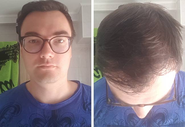 risultato dopo 5 mesi dal trapianto di capelli dhi da 3500 innesti di Chris Scholz