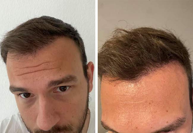 Risultato dopo 6 mesi dal trapianto di capelli zaffiro da 4500 innesti di Sefket Ahmetovic
