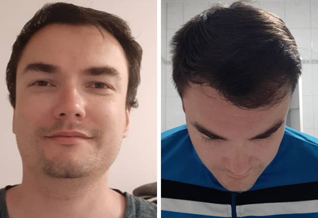 risultato dopo 7 mesi dal trapianto di capelli dhi da 3500 innesti di Chris Scholz