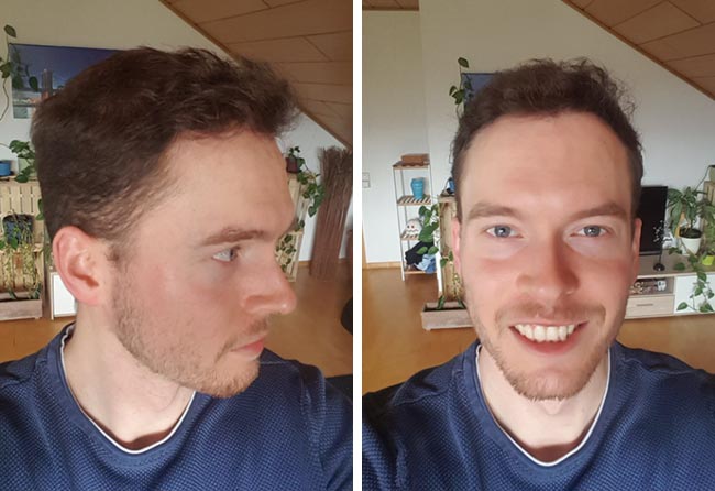 foto del risultato del trapianto di capelli DHI da 3500 innesti di Lukas Jaeger