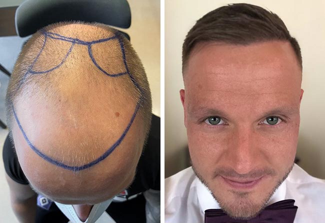 Foto di prima e dopo il trapianto di capelli DHI da 5200 innesti di Dominik König