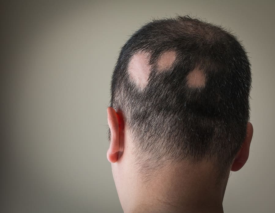 Testa di un uomo affetta da perdita di capelli circolare causata da alopecia areata
