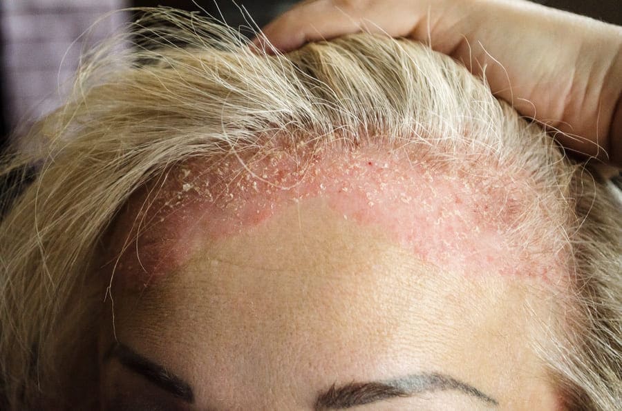 foto di una donna che soffre di psoriasi del cuoio capelluto, una malattia che può fare cadere i capelli