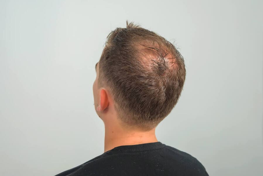foto di un uomo che ha bisogno di un trapianto di capelli su chierica per sconfiggere la sua calvizie